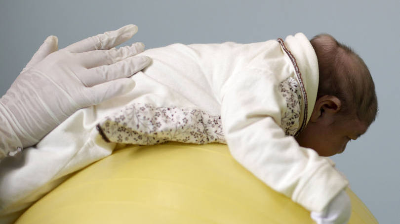 Bebê com microcefalia: o Brasil disse ter confirmado mais de 900 casos de microcefalia.